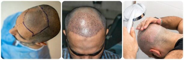 Best Fue hair transplant Pakistan