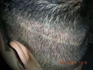 Read more about the article How long does fue procedure take