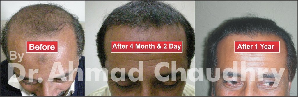 Best hair transplantation clinic Pakistan