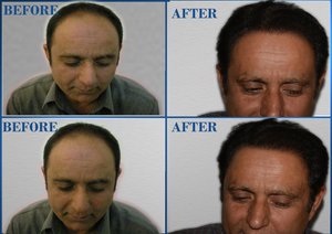 Density after hair transplant
