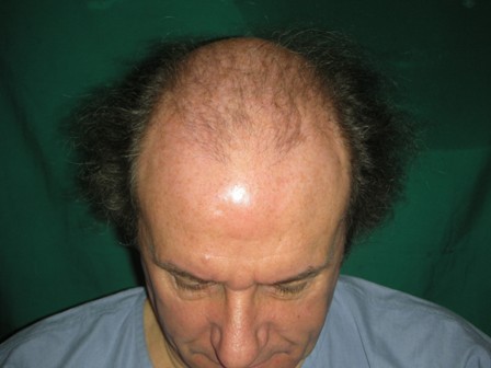 Hair transplant Lahore