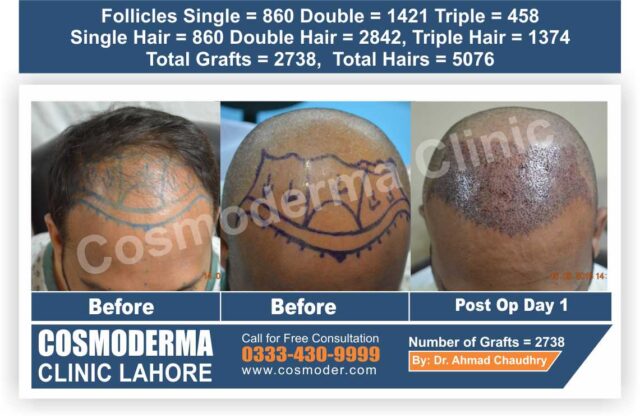 Hair transplant cost in Pakistan - Hair transplant cost in Pakistan -