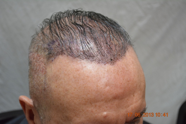 hair loss and hair transplant Pakistan