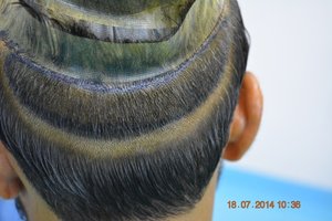 FUT Hair restoration Pakistan