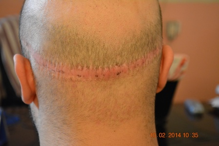 Fue hair transplant is suitable for keloids