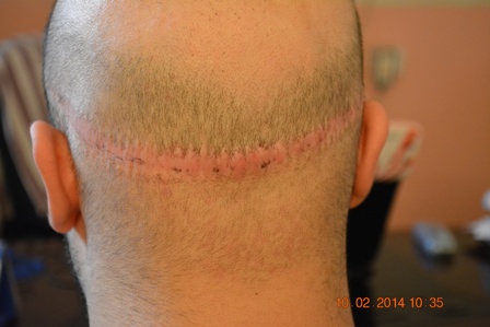 Fue hair transplant is suitable for keloids Fue hair transplant is suitable for keloids