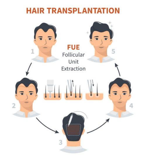 Read more about the article Fue Treatment