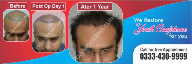 Read more about the article Hair growth with Fue Pakistan