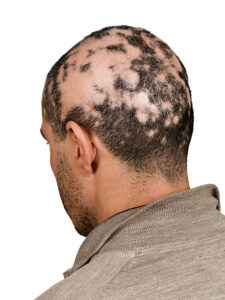 Read more about the article Alopecia treatment