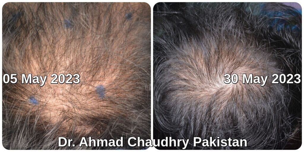 Hair loss Solutions for men in Pakistan natural resources
