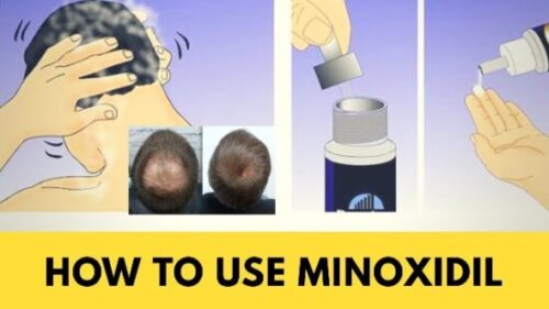 Rogaine Minoxidil Pakistan