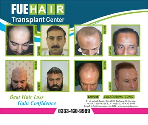 Read more about the article Fue hair transplant by Dr.Ahmad