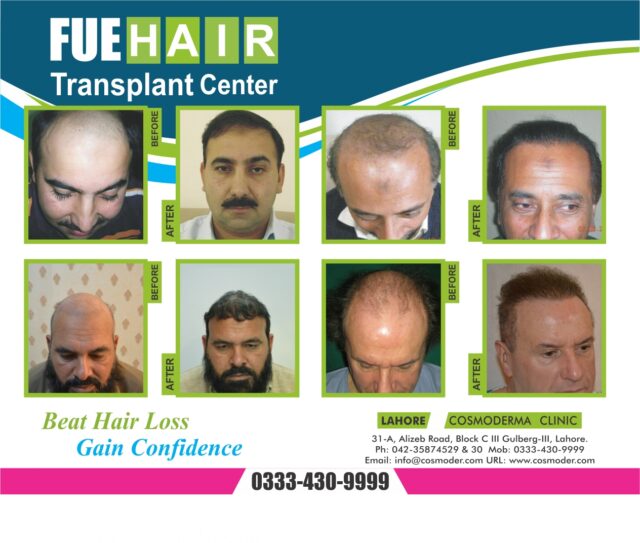 Fue hair transplant | Dr Ahmad Chaudhry hair restoration clinic in Pakistan
