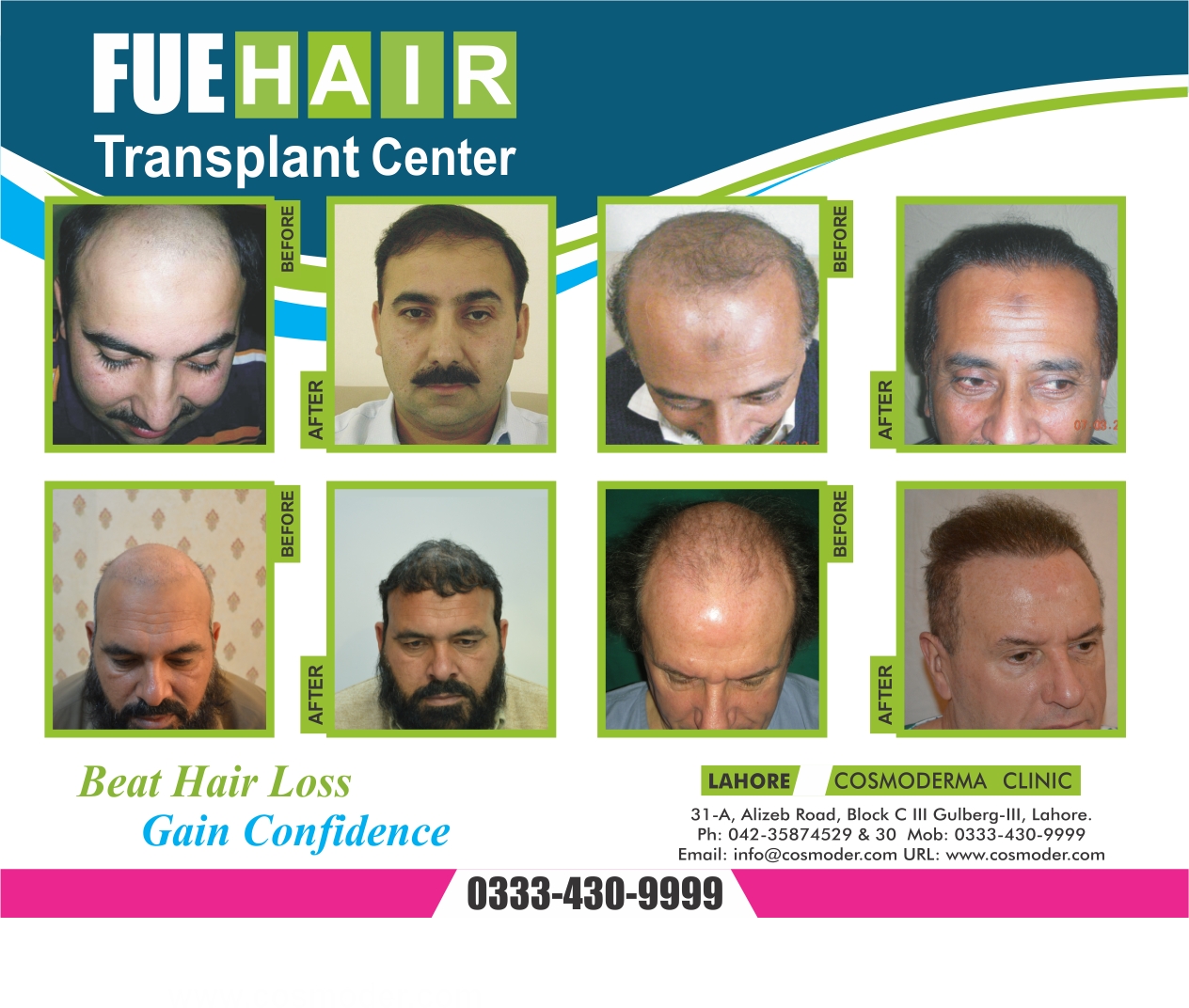 Realistic expectation regarding FUE hair transplant results in Pakistan