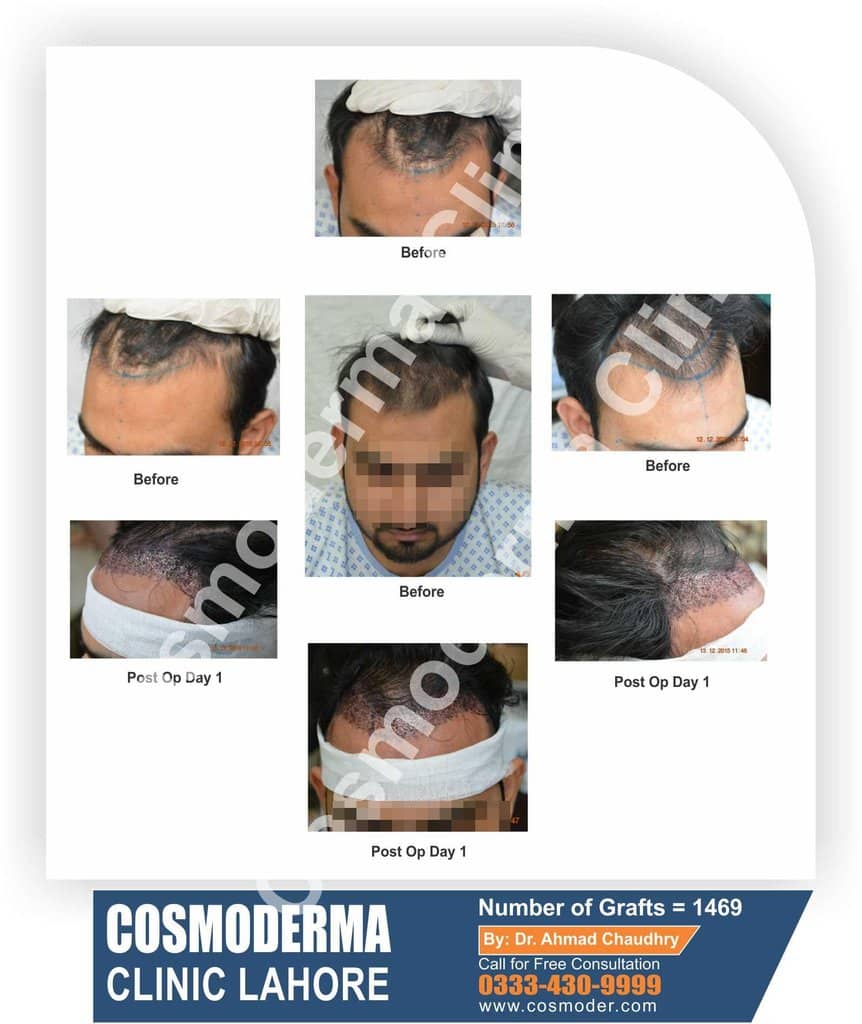 Frontal hairline hair transplant Pakistan