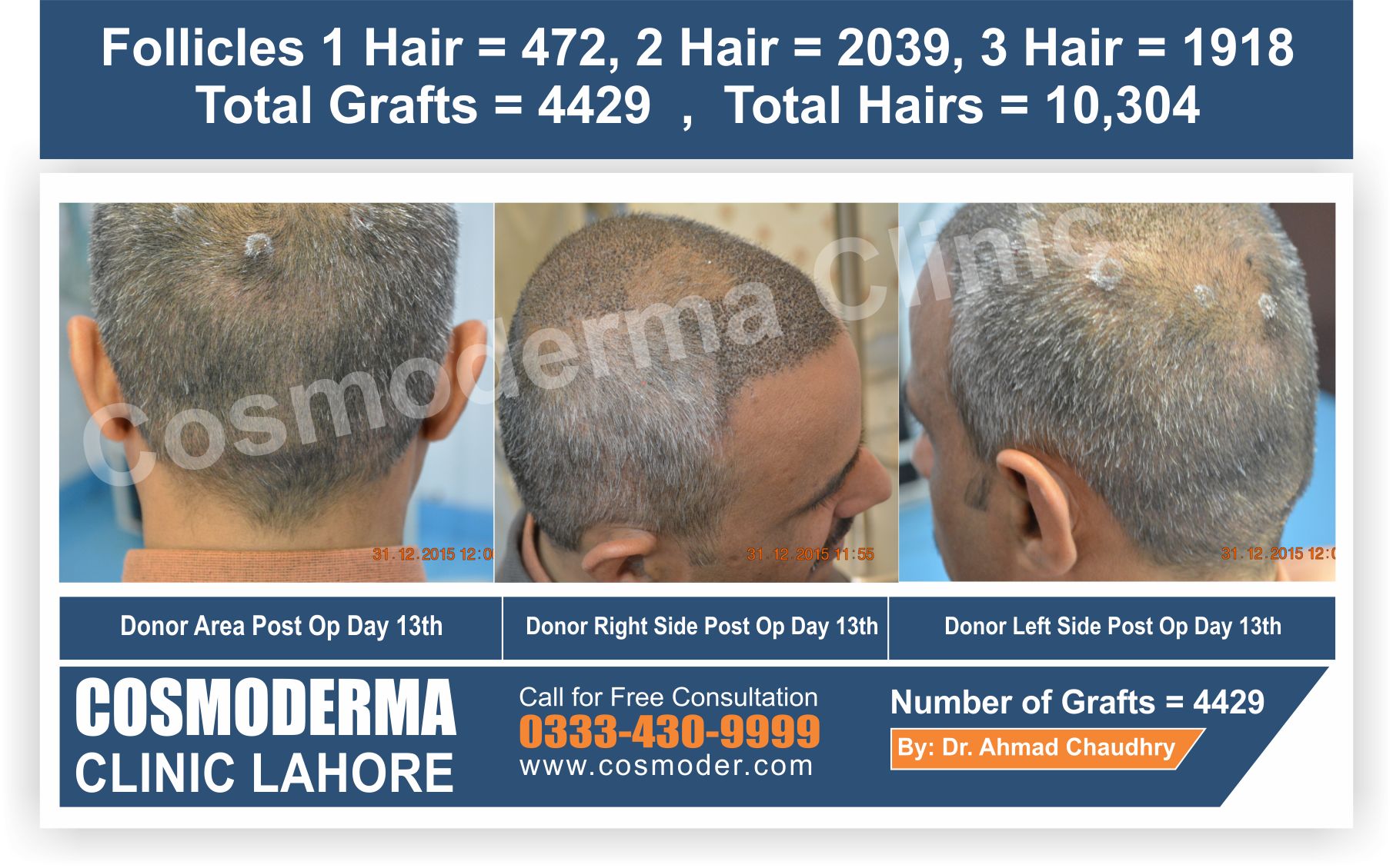 Fue donor area healing time | Hair transplant clinic Pakistan call us