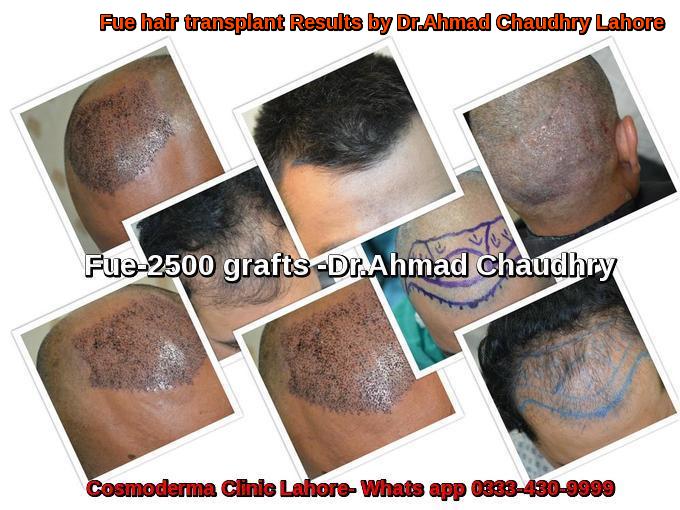 hair-transplant-in-narowal-patient