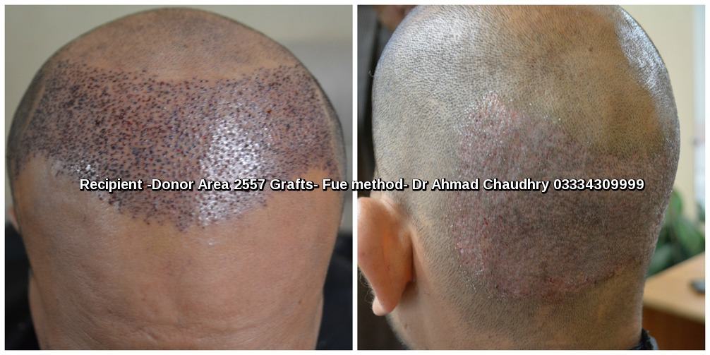 Fue hair transplant Mirpur Azad Kashmir