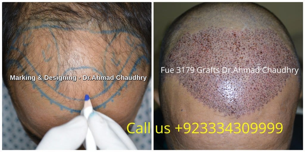 Fue hair transplant in Bahria Town Lahore