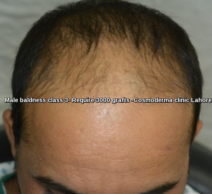 Hair Transplant Bahria Town