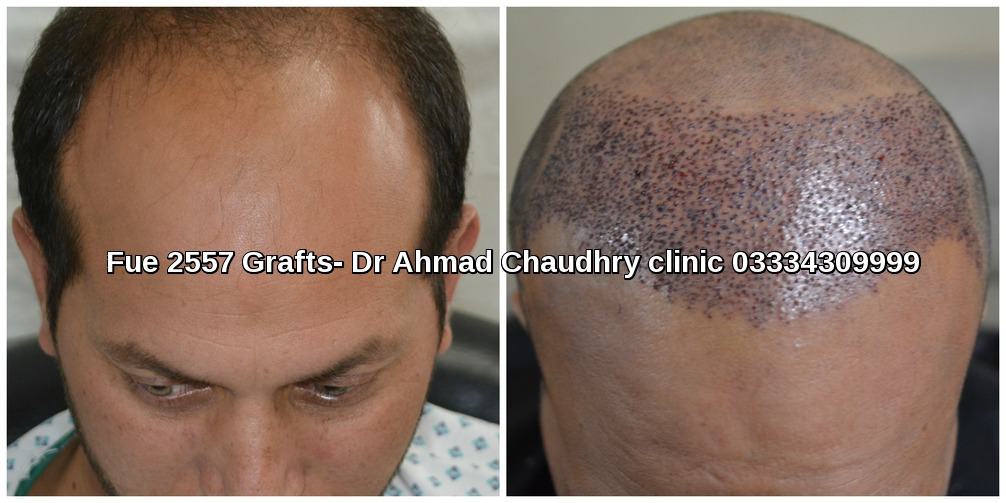 Hair transplant clinic Mirpur Azad Kashmir