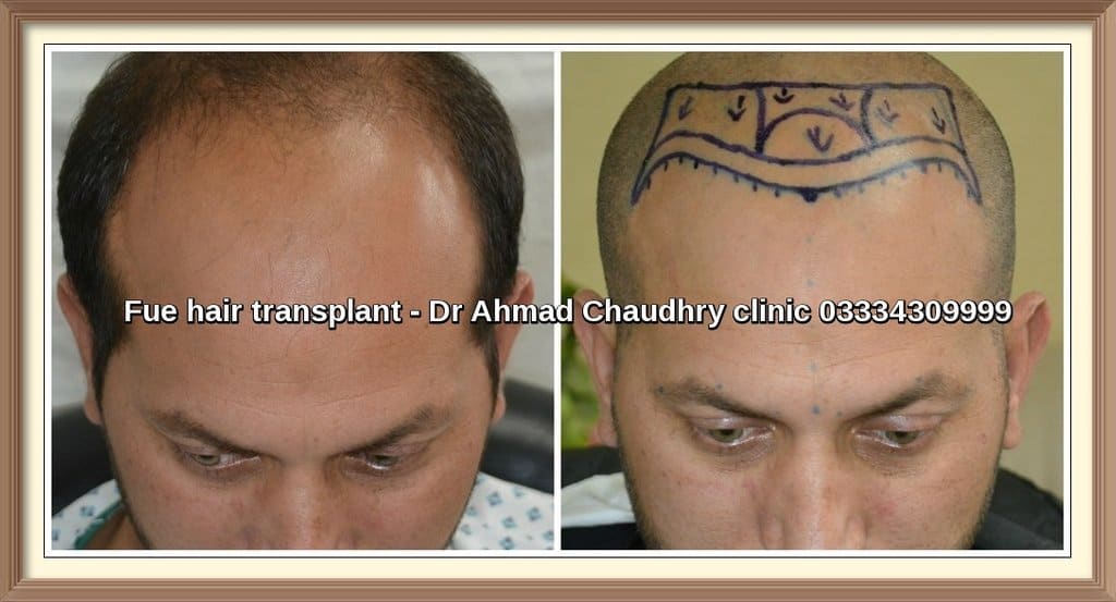 Hair transplant in Mirpur Azad Kashmir