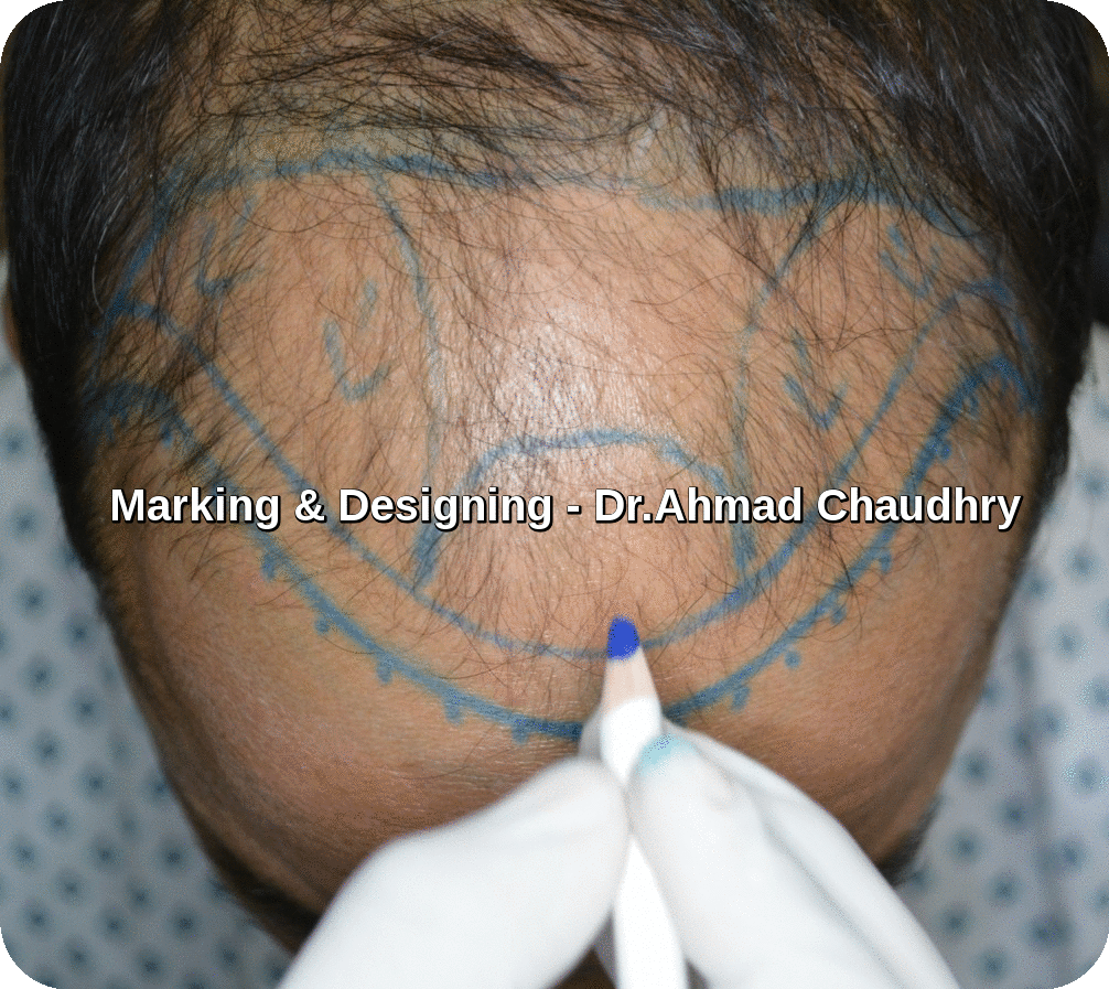 Hair transplant marking frontal area -Cosmoderma clinic Lahore