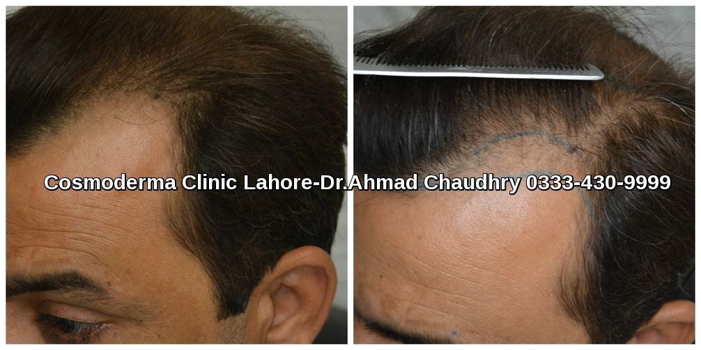 Fue hair transplant in Peshawar