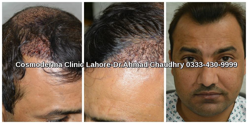 Hair transplant Peshawar patient photos | Free consultation call us now