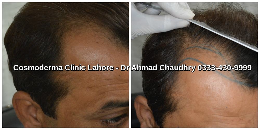 Hair transplant in Peshawar