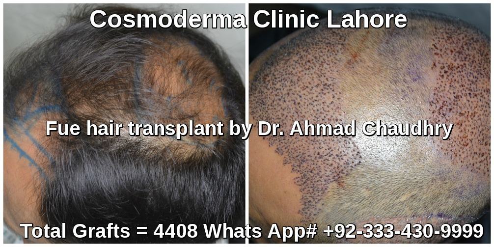 Fue hair transplant in Pretoria South Africa