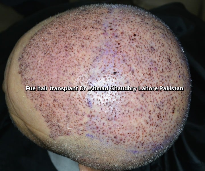 Fue hair transplant in Toronto