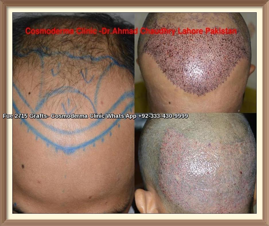 Hair Transplant Dammam Saudi Arabia