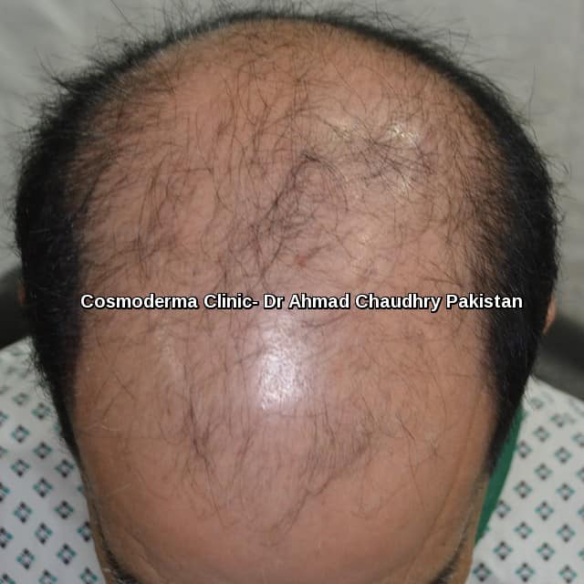 Hair transplant in Toronto