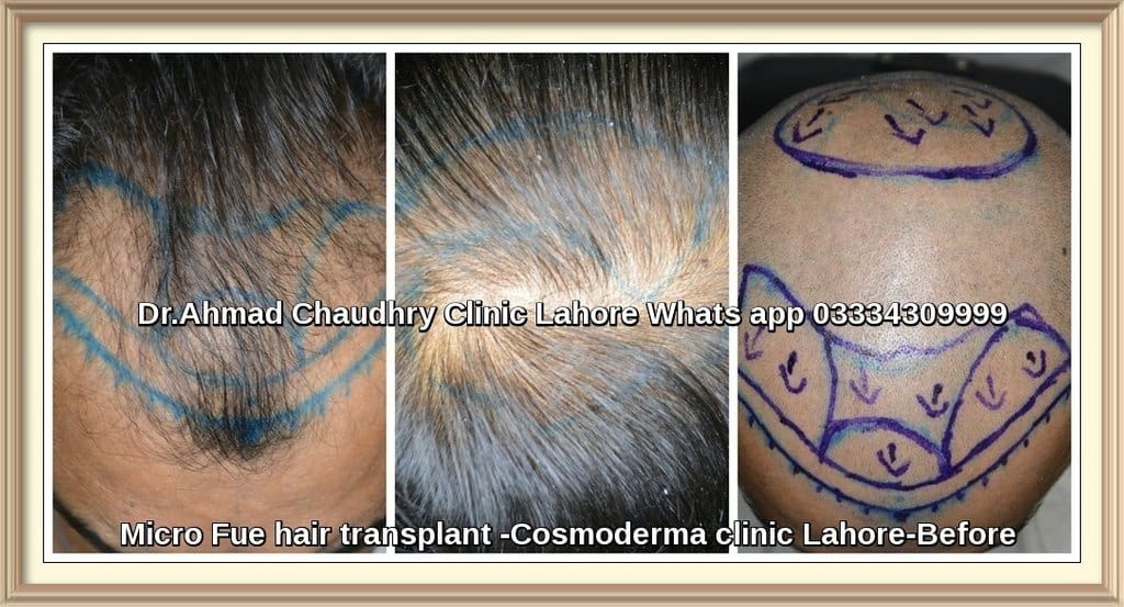 Fue hair transplant Jhang