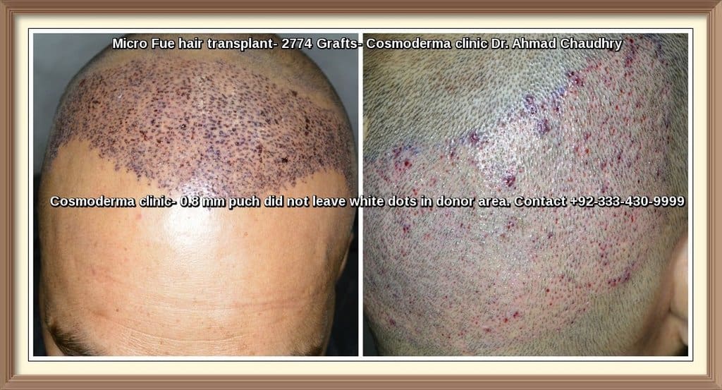 Micro Fue hair transplant Faisalabad