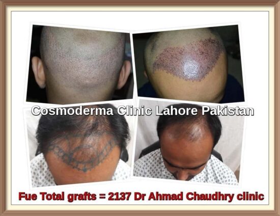 Fue hair transplant Queens NY - Fue hair transplant Queens NY -