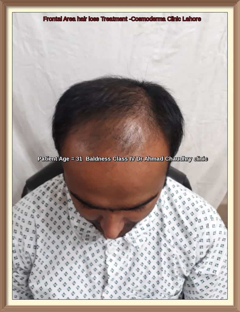 Hair Transplant New York Patient -2137 grafts -Cosmoderma Hair Clinic