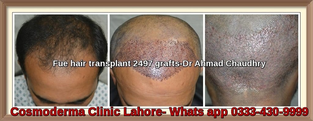 Fue hair transplant Pasrur Sialkot 2497 grafts