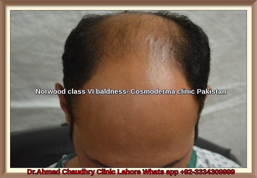 Hair transplant Jeddah