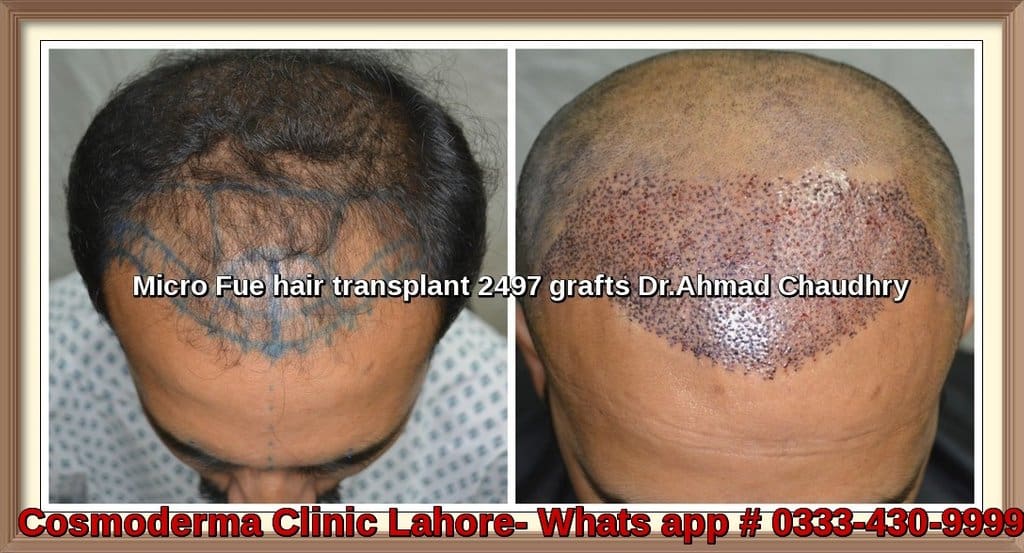 Hair transplant Pasrur Sialkot patient