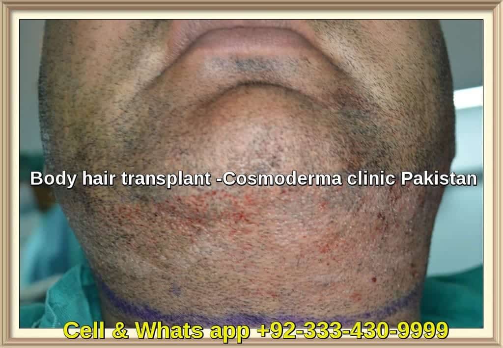 Body hair transplant in Pakistan