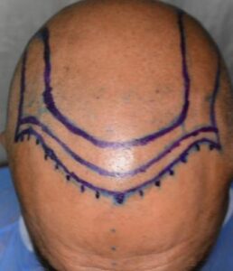 Frontal hairline and lateral hum correction