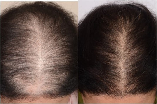 PRP for hair loss treatment results