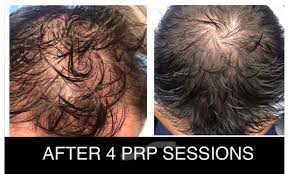 PRP for hair regrowth treatment