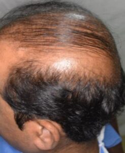 Picture of hair transplant cosmetic problem