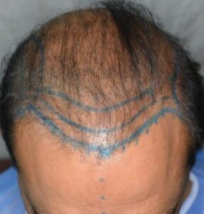 Repairing front hairline - adding more density