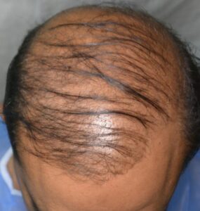 pictures of hair transplant side effects