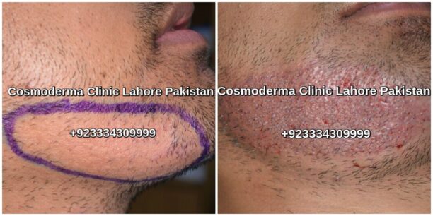 Beard hair transplant Lahore Pakistan