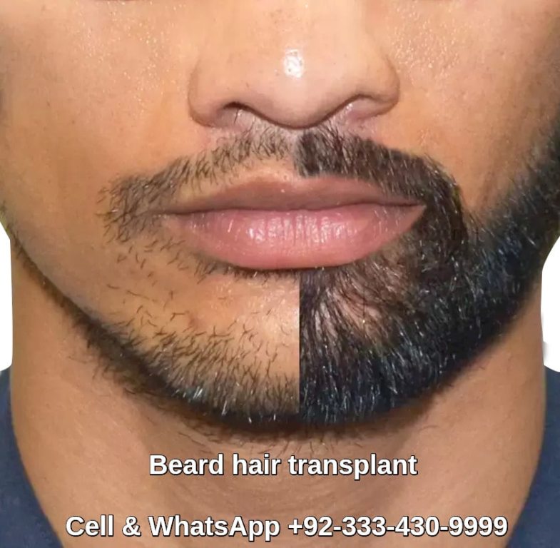 Beard hair transplant